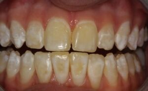 blanqueamiento dental en envigado