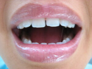 diseño de sonrisa en Envigado