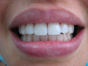 diseno de sonrisa en Envigado